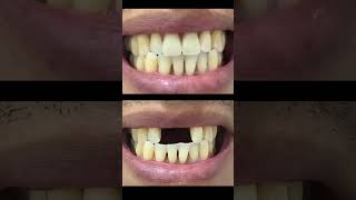 Restoration of upper anterior teeth  Denture shorts dentist youtubeshorts [upl. by Drew533]