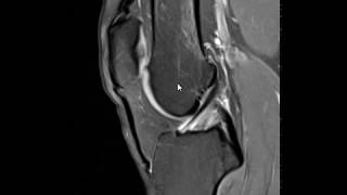 Fatty impingement in anterior knee [upl. by Tupler567]