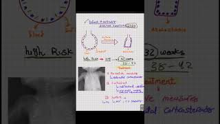 Infant Respiratory Distress Syndrome شرح حالة IRDS انشروهاللاستفادة [upl. by Enenej]