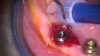 peri implant mucositis treatment [upl. by Jonathon391]