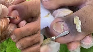 Top ASMR Expert Shares Ear Wax Removal Secrets យូយៗបងអើយកប់ ហើមស្ពីង😂😂 nail​​​ asmr fyp ear [upl. by Sackville]