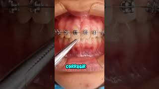 Mejora tus dientes con los fierros dentales dientes dentista tips parati viral fyp [upl. by Norvil]