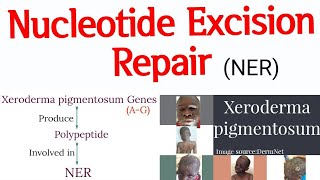 DNA Repair mechanism  Nucleotide Excision Repair II Xeroderma pigmentosum cause and features [upl. by Rodolfo]