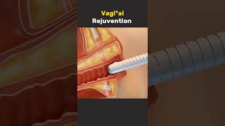 Vaginal Rejuvenation [upl. by Winther314]