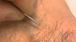 How to remove an ingrown hair [upl. by Anawak]