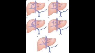 Portosystemic Shunt Surgical procedure  Definition Indications Procedure Types Advantages [upl. by Wally]