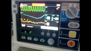 Ventricular Tachycardia in Cardiac Monitor [upl. by Yedarb]