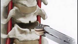 SecureC Cervical artificial disc Replacement Hussien ElMaghraby [upl. by Atekin]