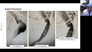 ALTO Stent Graft  Case Review MM2739US Rev 01 [upl. by Eceinart]