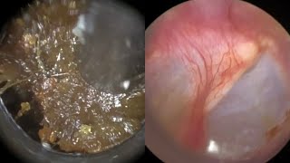 173  Ear Wax Removal In Bruised Ear Stained with Blood due to Cotton Swab Misuse with the WAXscope [upl. by Wobniar682]