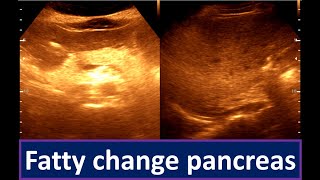 Moderately diffuse fatty infiltration of the Liver  Fatty change pancreas [upl. by Catrina]