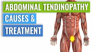 Abdominal Tendinopathy  Causes and Treatment Including Exercises [upl. by Aihtenak517]