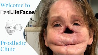 Welcome to Real Life Faces Prosthetic Clinic [upl. by Notsreik]