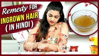 Ingrown Hair Removal At Home  Remedy For Ingrown Hair In Hindi  DIY  Ingrown Hair Treatment [upl. by Noni]