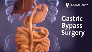 Gastric Bypass Surgery  Duke Health [upl. by Sirc]