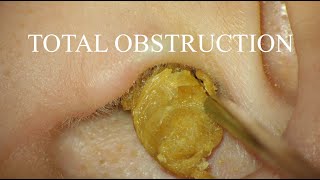 TOTAL OBSTRUCTION  EAR WAX REMOVAL  4KHD [upl. by Tav]