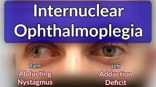 Internuclear Ophthalmoplegia  Left INO Case example explained [upl. by Dnumsed965]