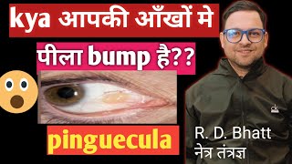 Pinguecula couses and Treatment pinguecula kya होता है और इसका ईलाज़ पीला bump [upl. by Negroj362]