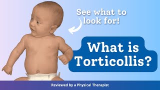 What is Torticollis [upl. by Eihpos]