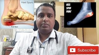 HEEL PAINCALCANEAL SPUR TREATMENTएड़ी के दर्द का इलाज [upl. by Grube]