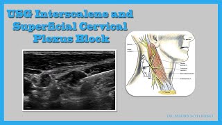 USG Interscalene and Superficial Cervical Plexus Block [upl. by Llirrehs]