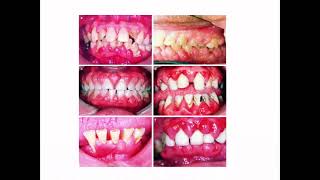 Gingival enlargement [upl. by Ahseyt]