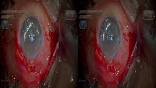 ACIOL explantation plus iris claw Dr Sourabh Patwardhan Live Cataract surgery call 7028402375 [upl. by Petta307]