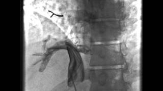 Stenosed Intrahepatic segment of IVC [upl. by Nylicaj234]