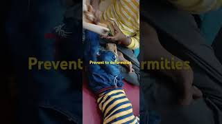 Prevent Deformaties Ankle Foot orthotics and Gaiters child with Cerebral Palsy [upl. by Fernyak44]