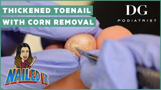 Thickened toenail with corn removal treatment subungual corn  The Foot Scraper DG Podiatrist [upl. by Ahseinaj287]