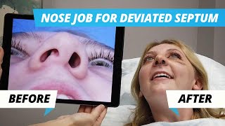 Nose Job Surgery for Deviated Septum – Rhinoplasty to Improve Crooked Nose [upl. by Ayokal]