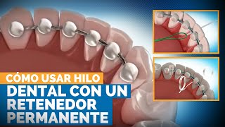 Cómo Usar Hilo Dental Con Un Retenedor Permanente  Premier Orthodontics [upl. by Coral]