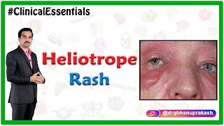 Heliotrope rash in Dermatomyositis  Clinical Essentials [upl. by Anaeda]