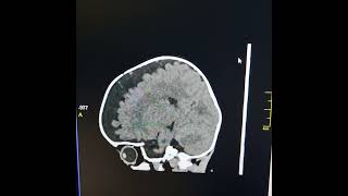 Agenesis of corpus callosum  External hydrocephalus [upl. by Oriole]