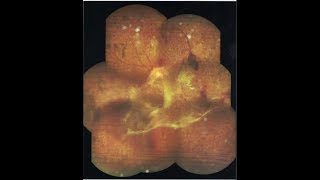 Vitreous Adhesions Diagnosis amp Treatment [upl. by Halimak]