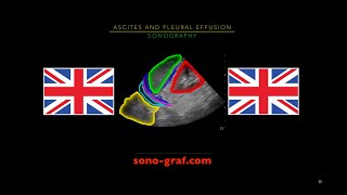 Sonography  Ascites And Pleural Effusion [upl. by Aldwon39]