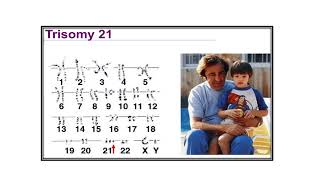 Chromosomal abnormalities Video No 498 [upl. by Gula]