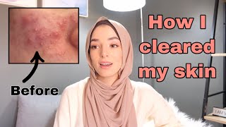 HOW I FINALLY GOT RID OF MY ACNE [upl. by Alyda533]