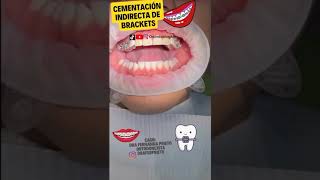 Cementación indirecta de brackets 😬 [upl. by Yruy]