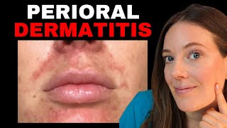 How to Treat Red Bumps Around the Mouth  Perioral Dermatitis [upl. by Ornstead]