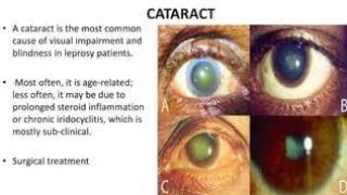 Effects of Leprosy on the Eyes [upl. by Hashimoto]