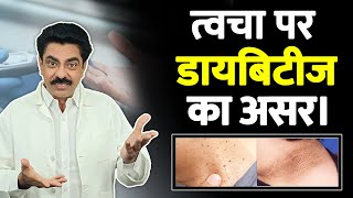 Common skin problems in diabetes  Skin Tags  Diabetes Sign amp Symptoms  Longlivelives Hindi [upl. by Hummel]