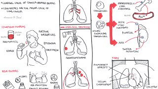 Lung Cancer  Overview [upl. by Vonny141]