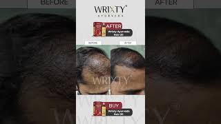 Check out these stunning Before amp After results using our Wrixty Ayurveda Hair Oil [upl. by Acirem615]