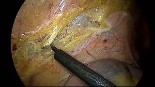 laparoscopic left hemicolectomy for carcinoma descending colon by Dr Rashesh Solanki [upl. by Sabsay]