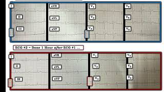 ECG Video Blog 407 — Why Did the Patient Die 12112023 [upl. by Anaujik]