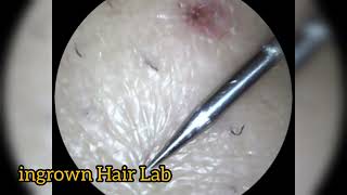 Ultimate Ingrown Hair Removal Compilation  Most Satisfying CloseUp Extractions [upl. by Erlina819]