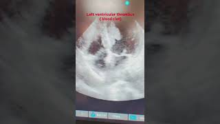 Left ventricular LV thrombus is a blood clot that forms in the hearts left ventricle [upl. by Purdum]