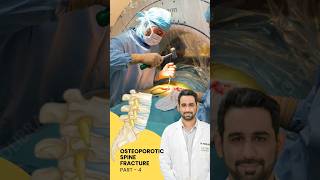 Treatment of Osteoporotic spine fracture  Dr Dheeraj Batheja  Part 2 doctor spinehealth [upl. by Arraeit206]