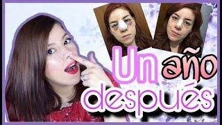 RINOPLASTIA 1 AÑO DESPUES  INFLAMACION  PUNTA DE PUERQUITO  MORETONES  CALLO ÓSEO [upl. by Heady498]